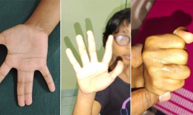 தூத்துக்குடி அரசு மருத்துவமனையில் சிறுமிக்கு பிளாஸ்டிக் சர்ஜரி : ஒட்டிய விரல்கள் பிரிக்கப்பட்டது!