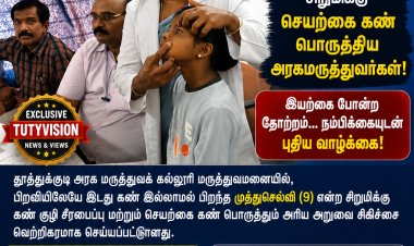 தூத்துக்குடி அரசு மருத்துவமனையில் அரிய சாதனை பிறவியிலேயே கண் இல்லாமல் பிறந்த 9 வயது சிறுமிக்கு செயற்கை கண் பொருத்தி வெற்றிகரமான அறுவை சிகிச்சை